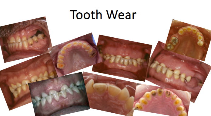 toothwear